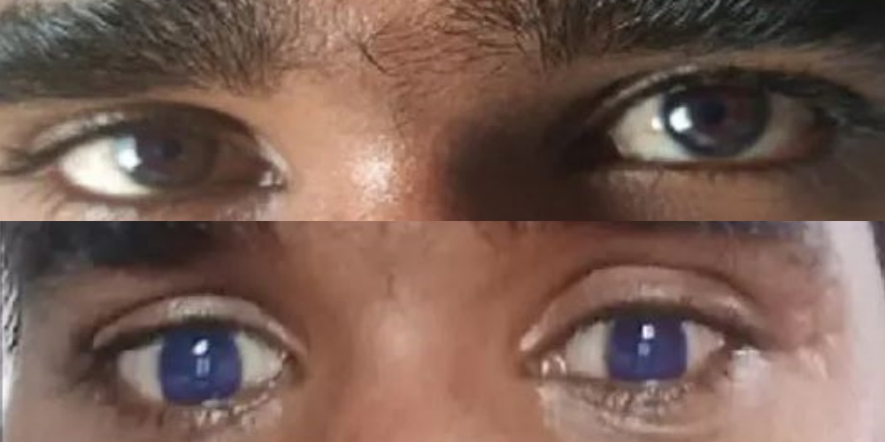 A 20-year-old man in India reported the first case of the unusual adverse effect of the treatment in 2021