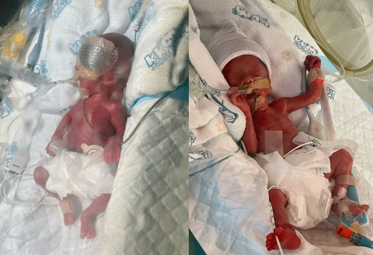 Baby Jun Chen, born extremely premature at 25 weeks, weighs only 590 grams. (Images via Give.Asia)
